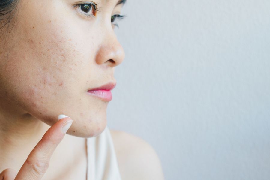 A woman applies acne cream to her face and worries about benzene in acne products.